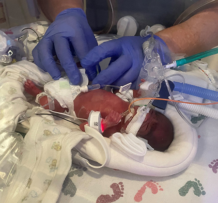 A small preemie baby with monitoring equipment on is gently touched by someone with blue medial gloves