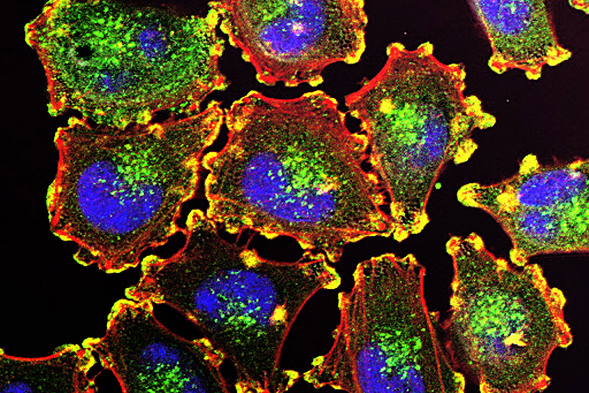 Metastatic melanoma cells.