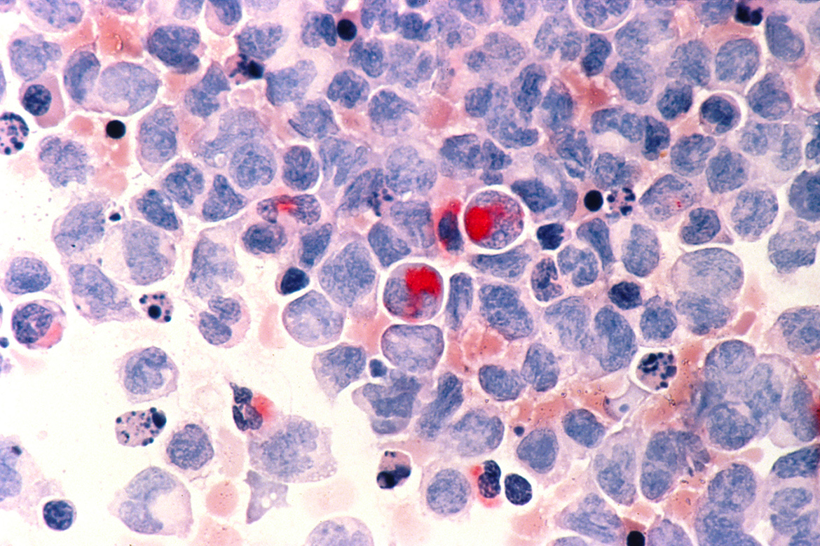 Human cells with acute myelocytic leukemia (AML) in the pericardial fluid, shown with an esterase stain at 400x.