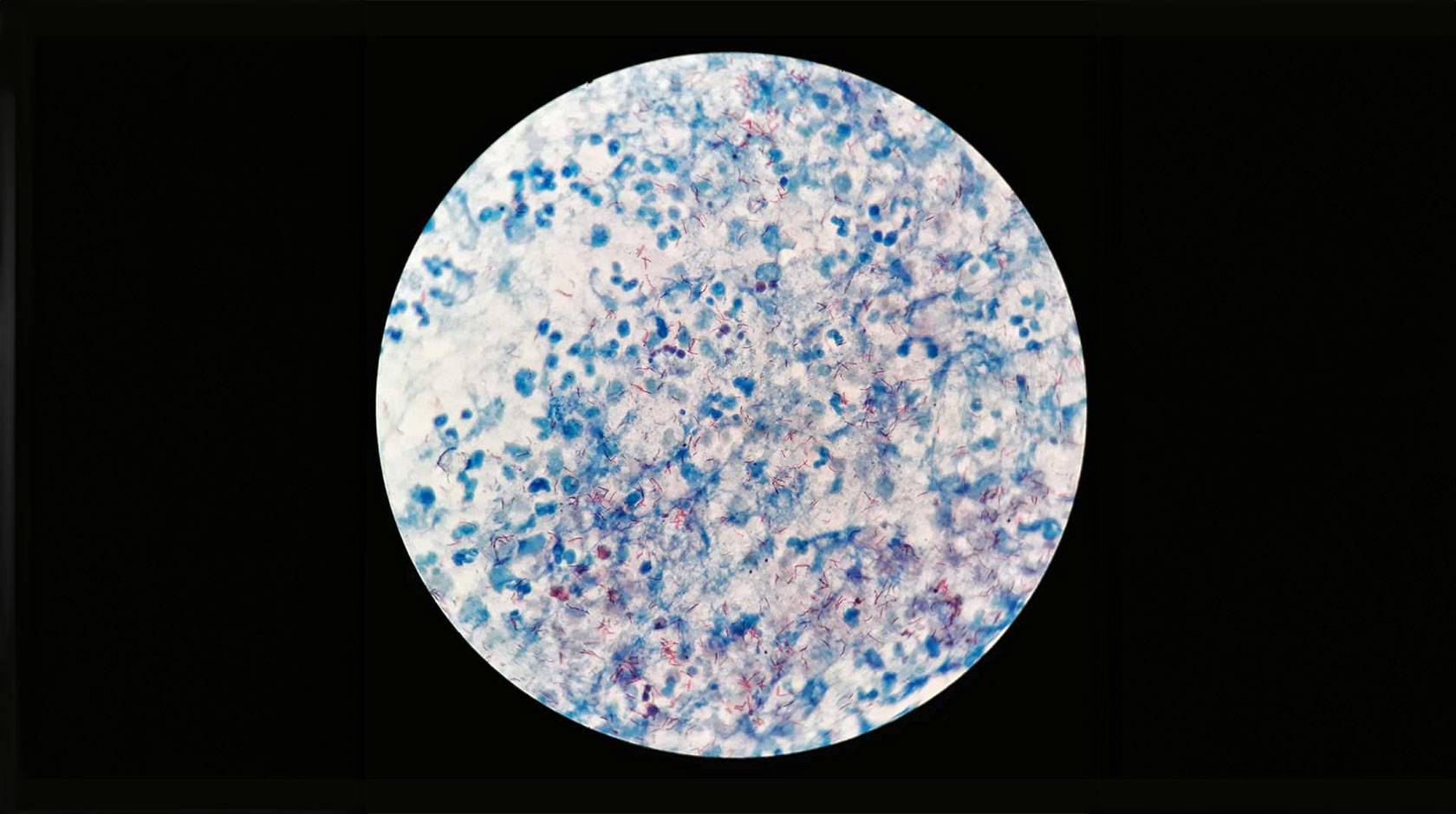 A microscope view of tuberculosis