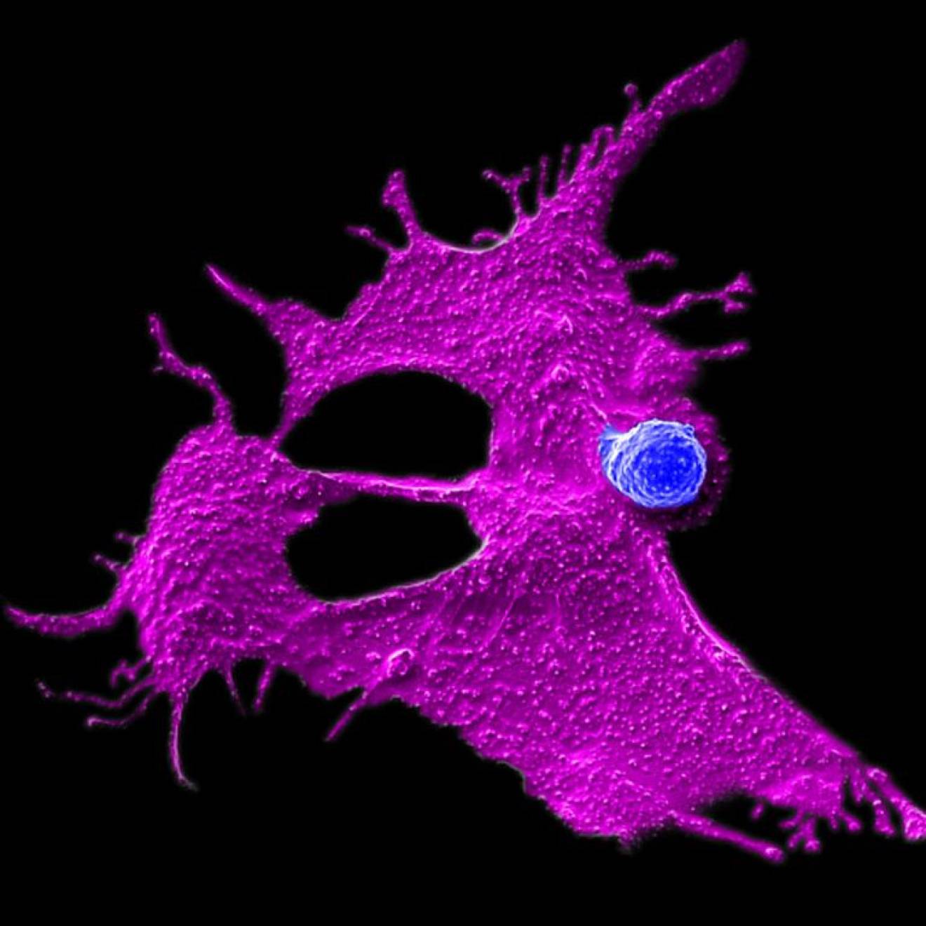 Microscopy image showing a very small stem cell-engineered CAR-NKT cell (blue dot) attacking a human solid tumor cell (magenta spread out, amoeba-like shape)
